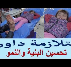 Embedded thumbnail for متلازمة  داون علاج الاطفال REFLEXOLOGY FOR Down syndrome